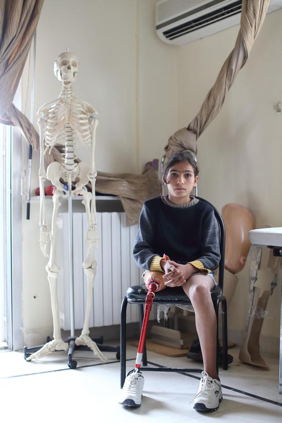 （一名13岁的叙利亚女孩儿在当地红新月会假肢康复中心接受治疗 摄影：中国日报 王敬）